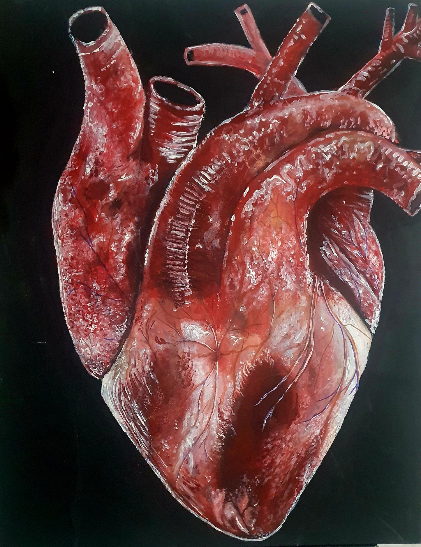Heart attack